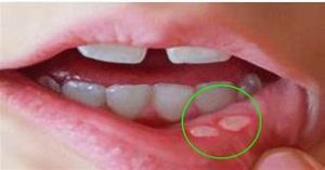 canker sore sores afte rimedi tratament bucale tongue ulcers ulcer corriereserale iata dailyhealthpost pochi sbarazzarsene bocca minuti aphthous bucala medicamentos