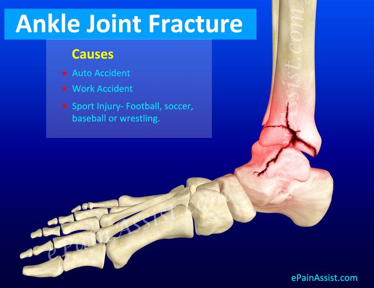 Ankle Joint Fracture Types Classification Symptoms | My XXX Hot Girl